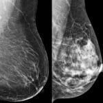 Mais do que a cor da pele, ancestralidade é indicadora de risco para câncer de mama, mostra estudo