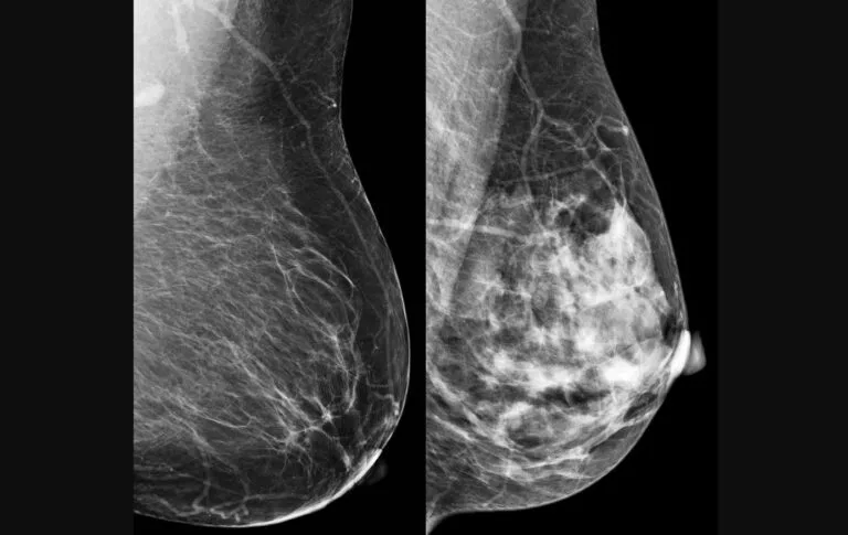 Mais do que a cor da pele, ancestralidade é indicadora de risco para câncer de mama, mostra estudo