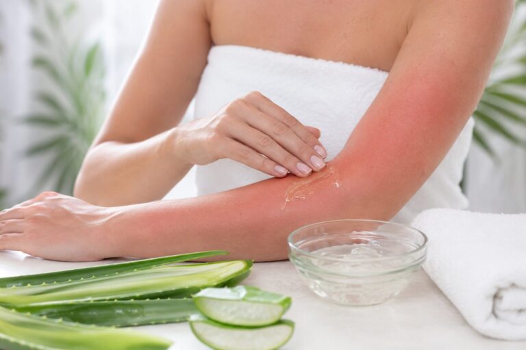 Pegou muito sol? Conheça 3 receitas caseiras para aliviar queimaduras leves do verão