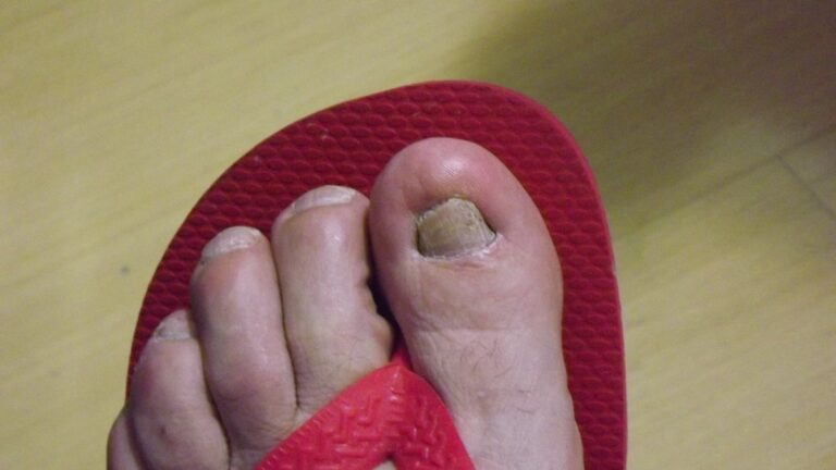Anvisa manda recolher 'regenerador de unhas' que promete eliminar 99% dos fungos: veja qual e por que é irregular