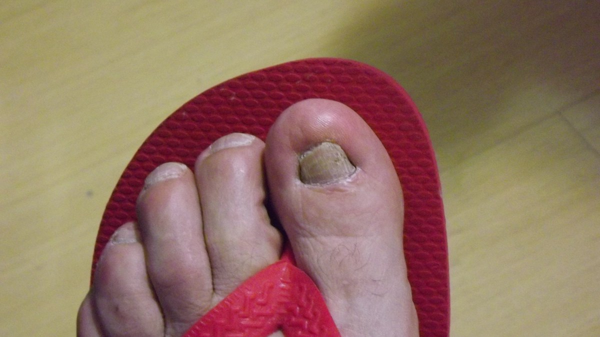 Anvisa manda recolher ‘regenerador de unhas’ que promete eliminar 99% dos fungos: veja qual e por que é irregular Anvisa manda recolher ‘regenerador de unhas’ que promete eliminar 99% dos fungos: veja qual e por que é irregular
