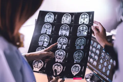 Mapa de 6 milhões de células do cérebro revela conexões entre Alzheimer, Parkinson e envelhecimento